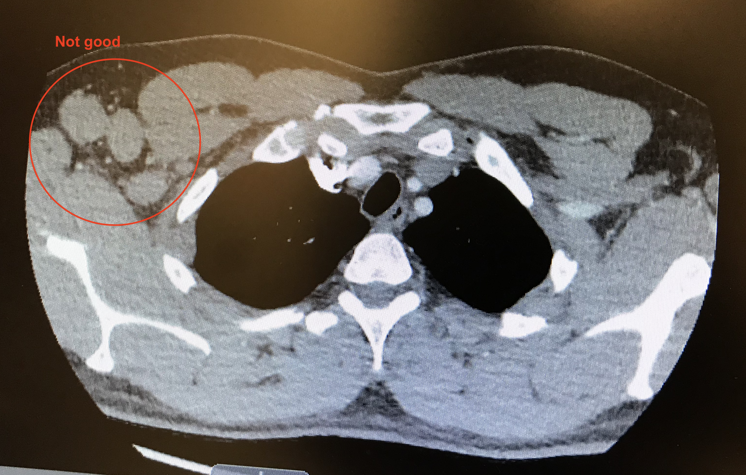 CT Scan of my chest